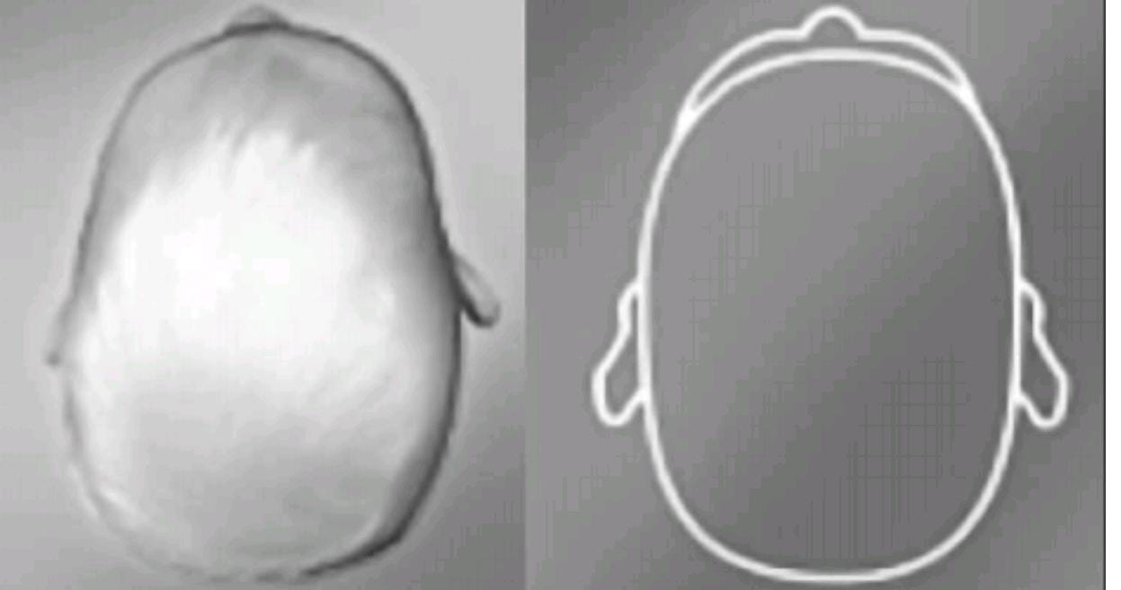 kraniyal kask